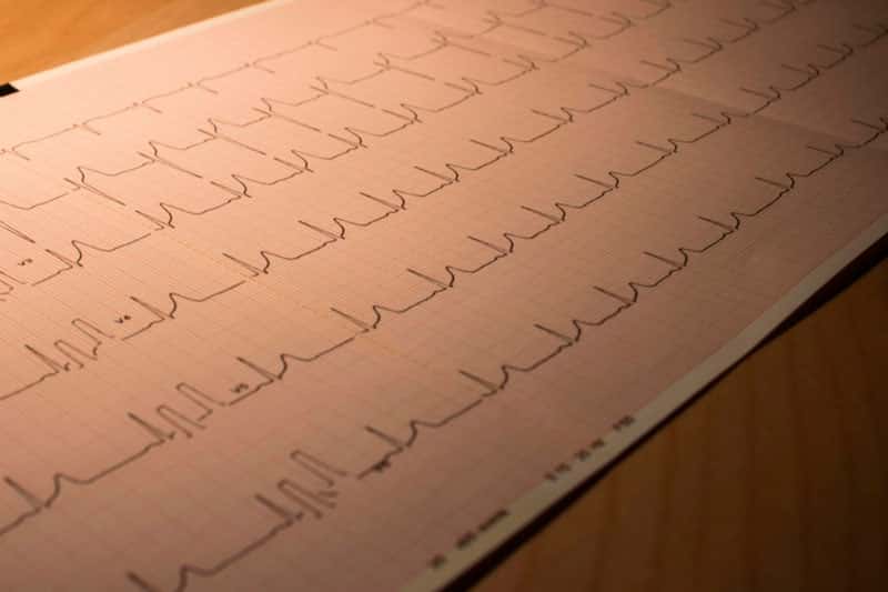 Сосудистый хирург назвал основные признаки атеросклероза 