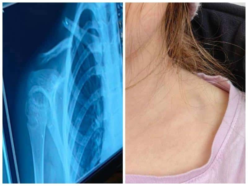 Школьница сломала ключицу на батуте в Каменске-Уральском: конфликт с владельцем игрового зала решен миром