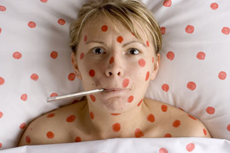 Роспотребнадзор по Свердловской области держит на контроле ситуацию с заболеваемостью корью среди жителей Екатеринбурга