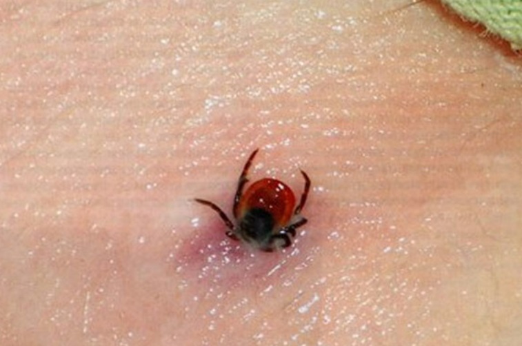 Клещи успели покусать 303 свердловчанина