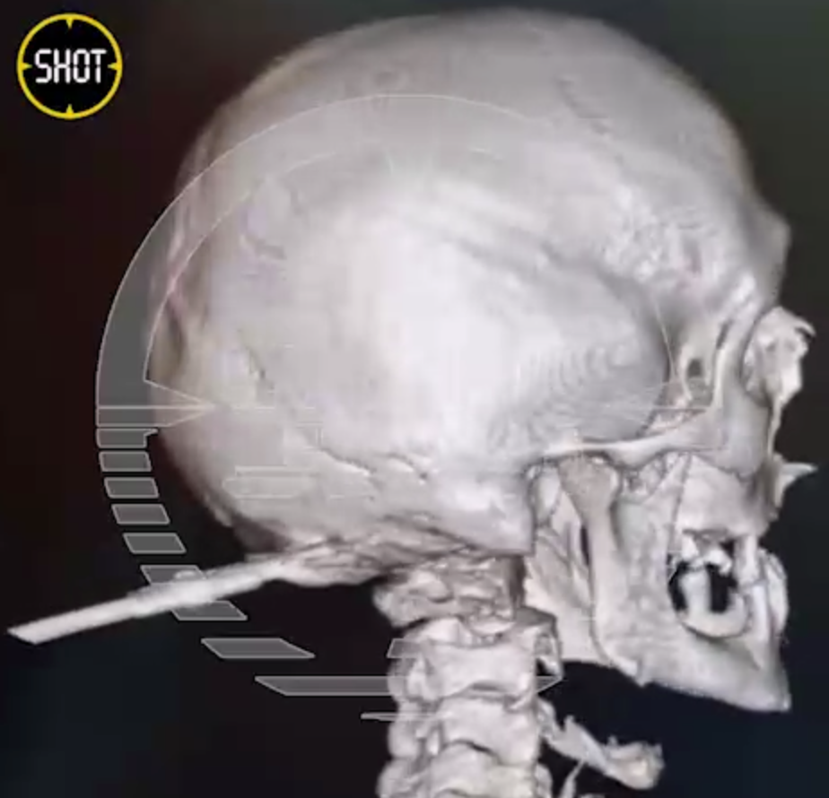 Отвёртку в голову воткнули мужчине из Башкирии | Отвёртку в голову воткнули мужчине из Башкирии Отвёртку в голову воткнули мужчине из Башкирии | Отвёртку в голову воткнули мужчине из Башкирии