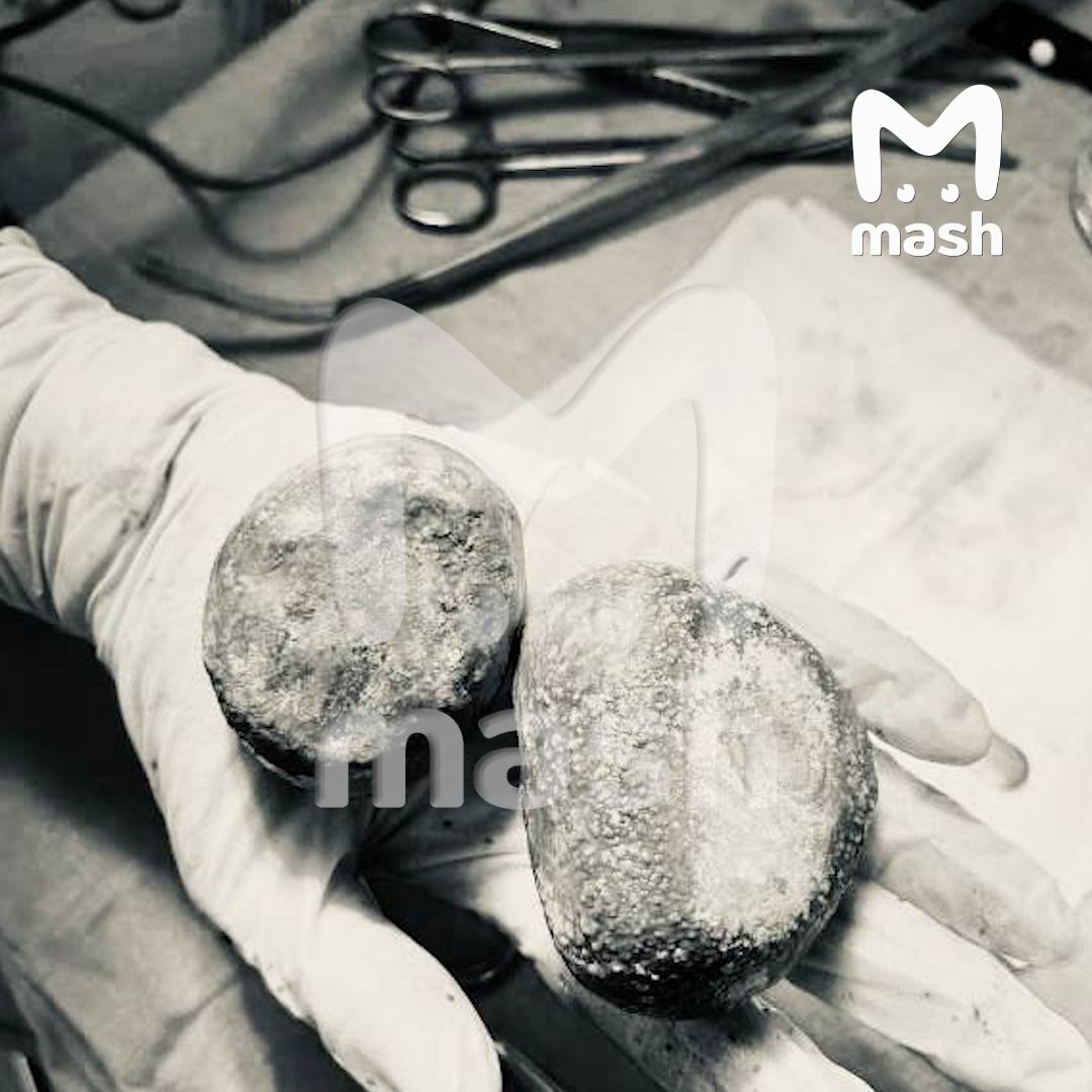 Уникальный медицинский случай: жительницу Электростали спасли от огромных камней в мочевом пузыре