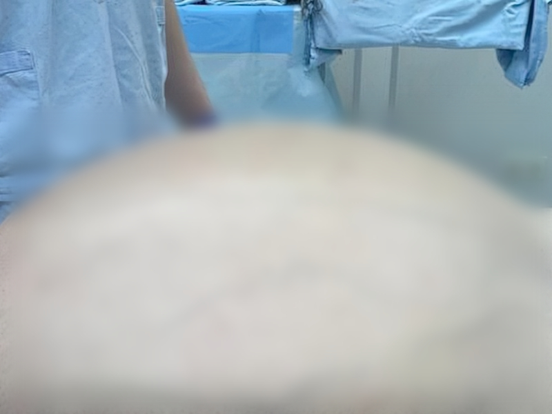 «Я с ней даже бегал»: врачи в Екатеринбурге вырезали пациенту опухоль весом 60 кг | Врачи Екатеринбурга удалили 60-килограммовую опухоль у пациента