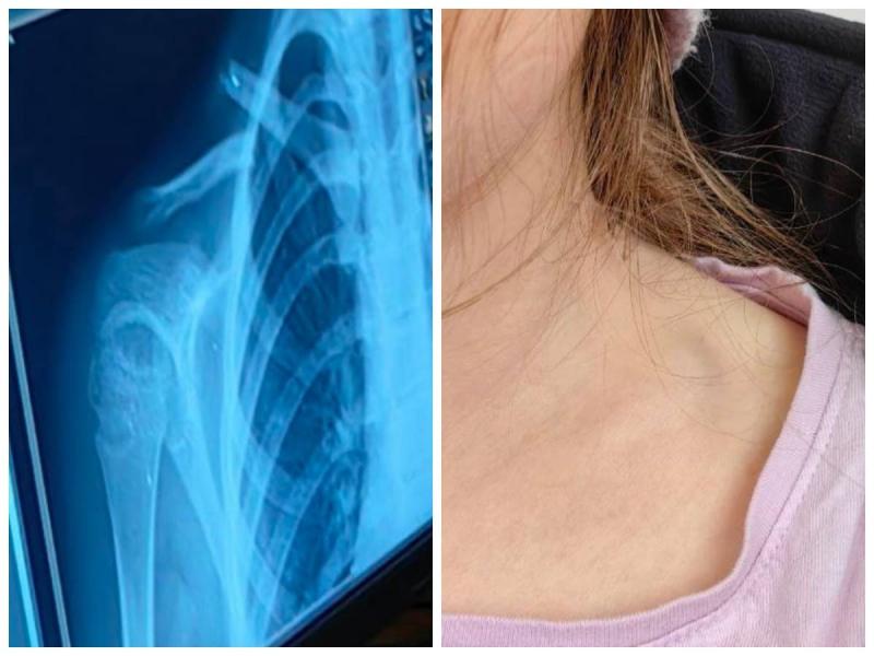 Школьница сломала ключицу на батуте в Каменске-Уральском: конфликт с владельцем игрового зала решен миром | В Каменске-Уральском школьница сломала ключицу на батуте, родители получили компенсацию